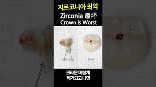 Zirconia Crowns are THE WORST. Get Composite Fillings instead of Crowns on Teeth w/ Root Canals