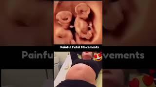 painful fetal movement #fetal #movement
