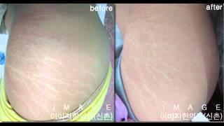 영화배우의 허벅지, 튼살, 핫팬츠, 후산한의원, st침, 튼살침 치료, stretchmark, 양악수술, 하지, 패인 튼살, 성형수술, 진피복원, 출산후 튼살, 배튼살, 종아리튼살