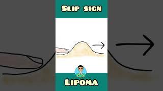 Slip sign in Lipoma | Surgery | #shorts