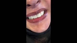 Smile Makeover in 1 Hour