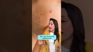 Acne in 30’s | what’s the cause | how to treat