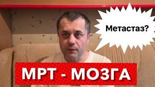 Рак Желудка - Метастаз в Мозге? Сделал сегодня МРТ Головного Мозга с контрастным усилением.