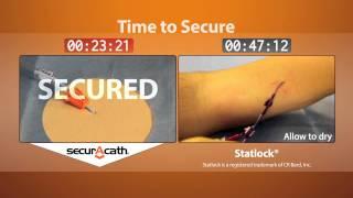 SecurAcath vs Statlock securement time