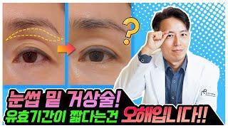 눈썹밑거상술이 효과가 없다구요? 아닙니다.