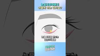 눈밑지방재배치 어떻게 하는 건가요? #눈밑성형 #beauty #눈밑지