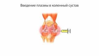 Плазмолифтинг коленного сустава