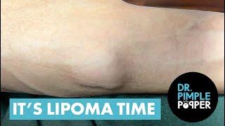 IT'S LIPOMA TIME with Dr. Pimple Popper