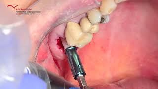 Zirconia Two Pieces Immediate Implant Placement (Tav Dental) with Osseodensification (Densah)