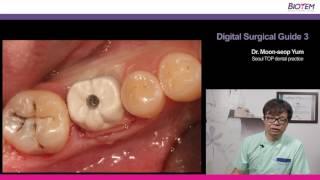 디지털 서지컬 가이드 3강 (Digital Surgical Guide 3) -바이오템 임플란트 BIOTEM IMPLANT