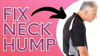 How You Can Get Rid of Neck Hump With a SOCK. Dowager's Hump.