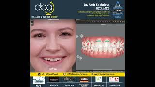Before / After Invisalign results by Dr Amit sachdeva