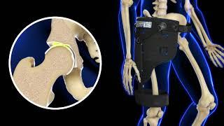 DonJoy EXCYABIR Hip Brace How it Works - Hip OA