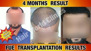 4Months Completed Best Results | Before and After Hair Transplant Results | Hair World Clinics