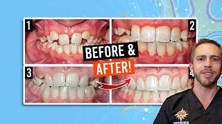 Phase 1 Braces Treatment [BEFORE & AFTER}