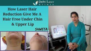 Patient Testimonial | Laser Hair Removal - Under Chin & Upper Lip | Delhi Laser Clinic