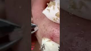 Skincare | Blackheads Removal #484 #tweezers skincare #blackheads blackheads