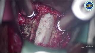 Artificial disc replacement (ADR). Assistant. Prof. Dr. Md. Sumon Rana