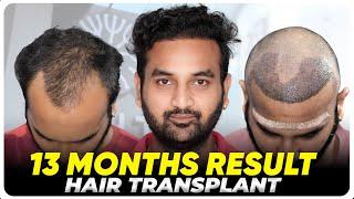 Hair Transplant in Boston | Best Results & Cost of Hair Transplant in Boston