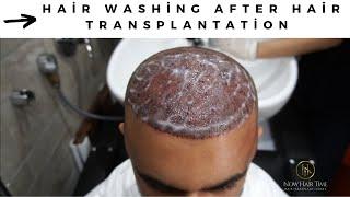 Hair washing after hair transplantation 