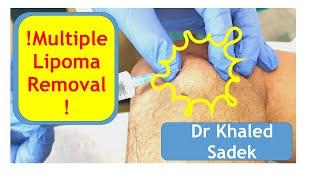 Multilple Lipoma Removal. Dr Khaled Sadek. London Cyst Clinic