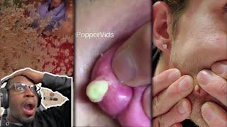 TIKTOK PIMPLE POP COMPILATIONS ARE GETTING OUT OF HAND!