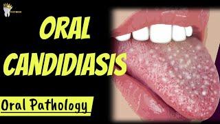 ORAL PATHOLOGY | ORAL CANDIDIASIS