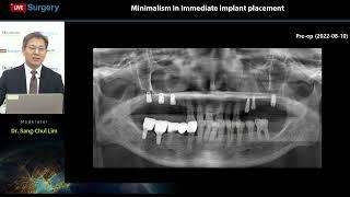 Dentium 220902 Live Surgery - Minimalism in immediate implant placement