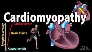 Cardiomyopathy, animation