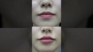 [닥터쁘띠] 사랑스러운 탱탱한 입술! 쭈굴쭈굴한 입술이여 이젠 안녕! 입술필러로 예쁜 입술 갖기! #피부과 #입술필러 #필러 #닥터쁘띠 #피부관리 #입꼬리 #입꼬리필러