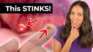 Tonsil Stones: The Hidden Cause of Bad Breath!