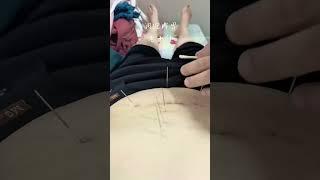 #传承中医文化 #中医针灸 #脾胃病#老十针