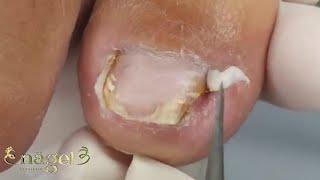 BIOMECÂNICA COMPROMETIDA QUE ACABA ENCRAVANDO A UNHA #satisfying #nails
