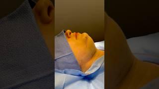 NECK LIPO + CHIN IMPLANT FOR A SNATCHED JAWLINE #jawlinecontouring #jawlinegoals #plasticsurgery