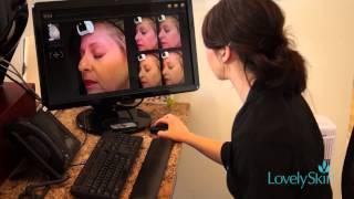 Visia Scan at LovelySkin