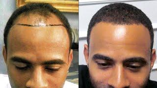 African American Frontal Hairline Reconstruction - Hair Restoration Specialists of Atlanta