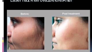 Laser Hair Removal in Delhi, Laser Hair Reduction in Delhi - Delhi Laser Clinic