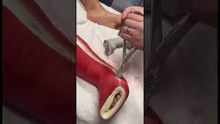 Removing a cast in 4 easy steps! | Boston Children's Hospital #castsaw #shorts