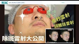 【除斑療程spot removal】大公開 | 曬斑Solar lentigo、老人斑Age spots 、痣naevus 除斑雷射大不同 | 治療方法對才有效 | 皮膚專科醫師張英睿