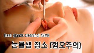 ASMR 수면클리닉 Eye Care 눈물샘 청소, 이물질이 가득찬 눈물샘.