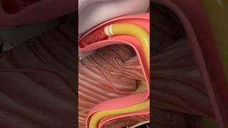 Mechanical Thrombectomy in stroke #medicine #anatomy #science #health #stroke