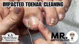 How to Fix Ingrown / Impacted Toenails at Home #nails #satisfying