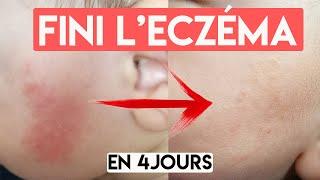 ECZÉMA ? LA SOLUTION NATURELLE & PAS CHÈRE 