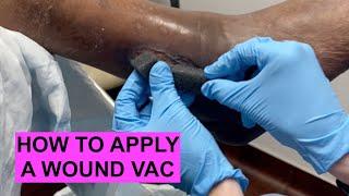 WOUND VAC Explanation & Tutorial!