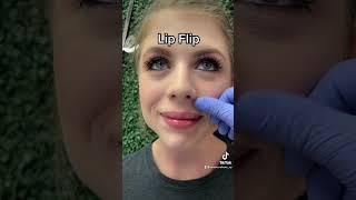 Botox/Dysport Lip Flip