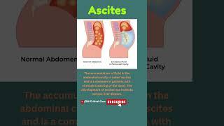 Ascites|Fluid Buildup in Peritoneal Cavity|Abdomen Disease| Ascites due to Liver Disease #ascites