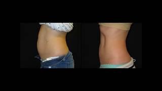 Dr. Johnathan Kramer | Before & After Video: CoolSculpting Case #7