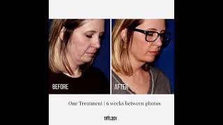 Coolsculpting Results at Trilogy Medical Center