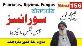 Psoriasis Agzima Fungus  || #156  ||  सोरायसिस  || سورائسز چنبل فنگس ایگزیما || Al Huda