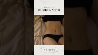 복부 지방흡입 리얼후기 #지방흡입후기